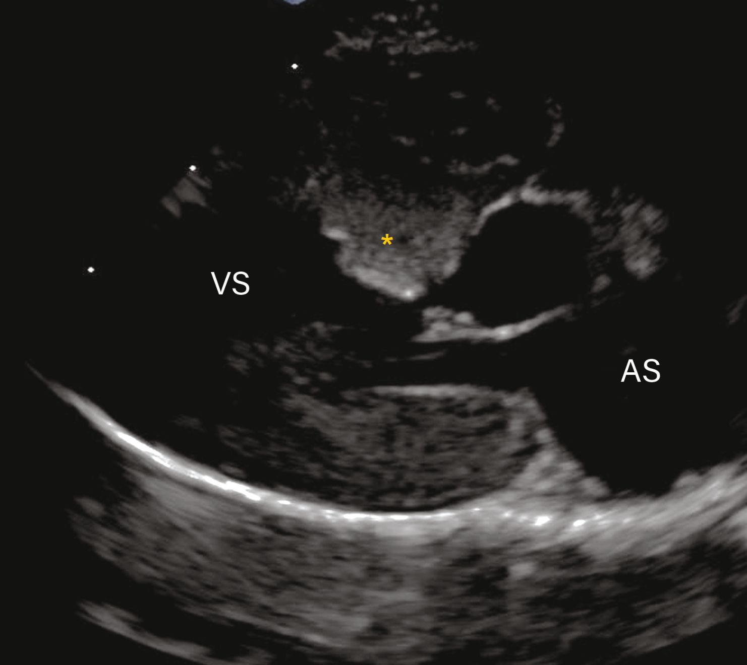 Observațiile ecocardiografice ale HCM pot să prezinte o mare variabilitate. 
