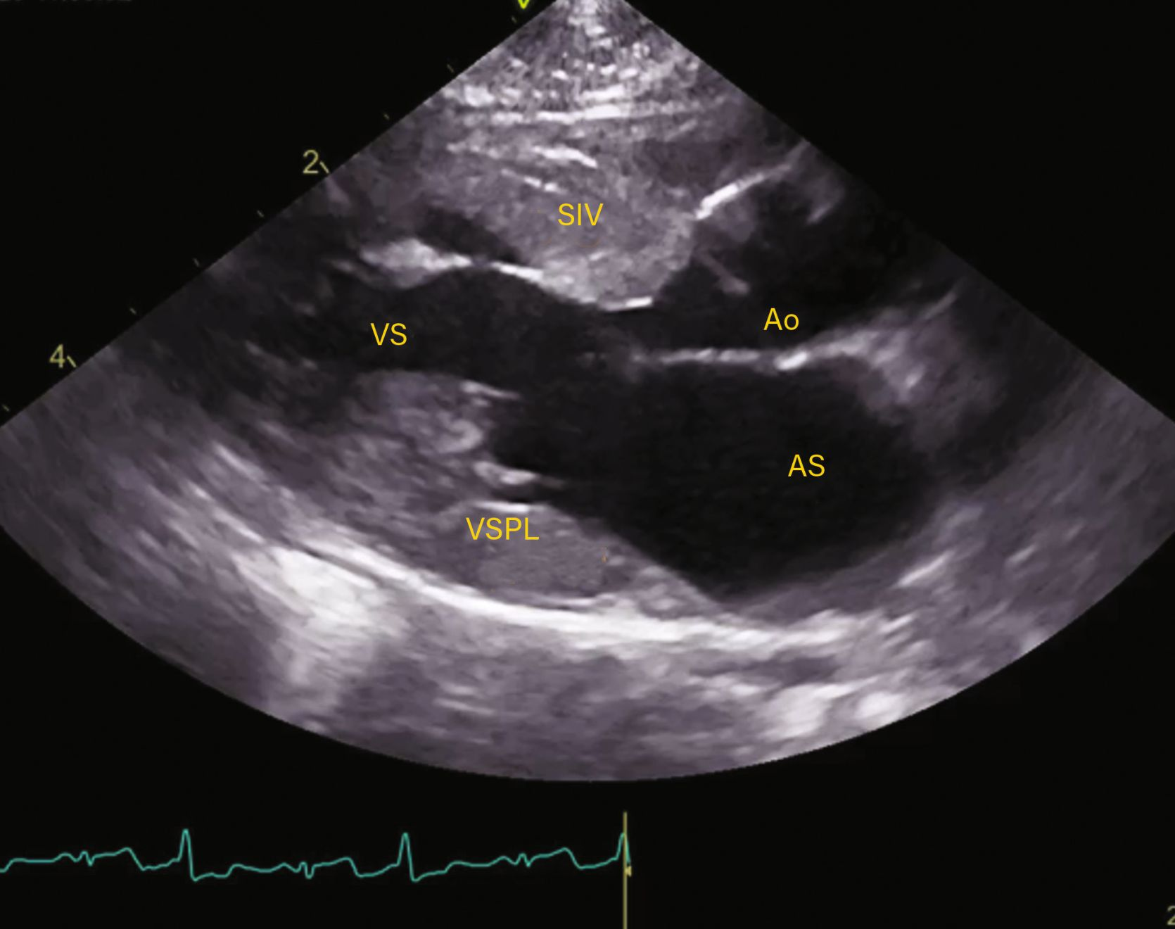 Evaluare ecocardiografică a cardiomiopatiei hipertrofice (HCM). 