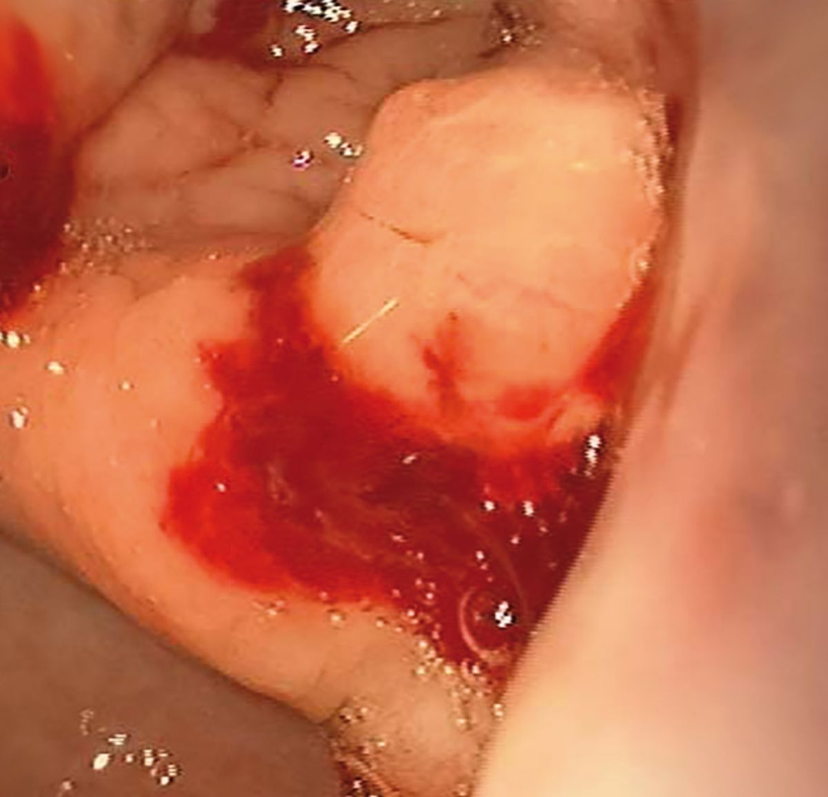Endoscopy revealed changes suggestive of gastric cancer. Note the polypoid, thickened angular notch, with post-biopsy bleeding.