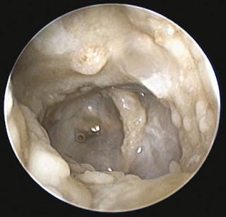 Otoscopia