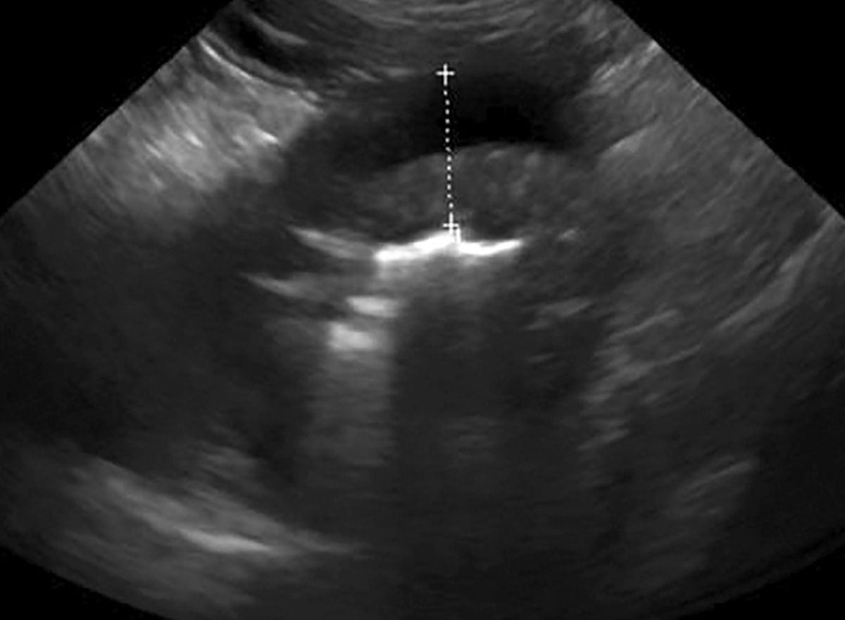 Abdominal ultrasonography of Case 3. Note the severely thickened gastric wall.