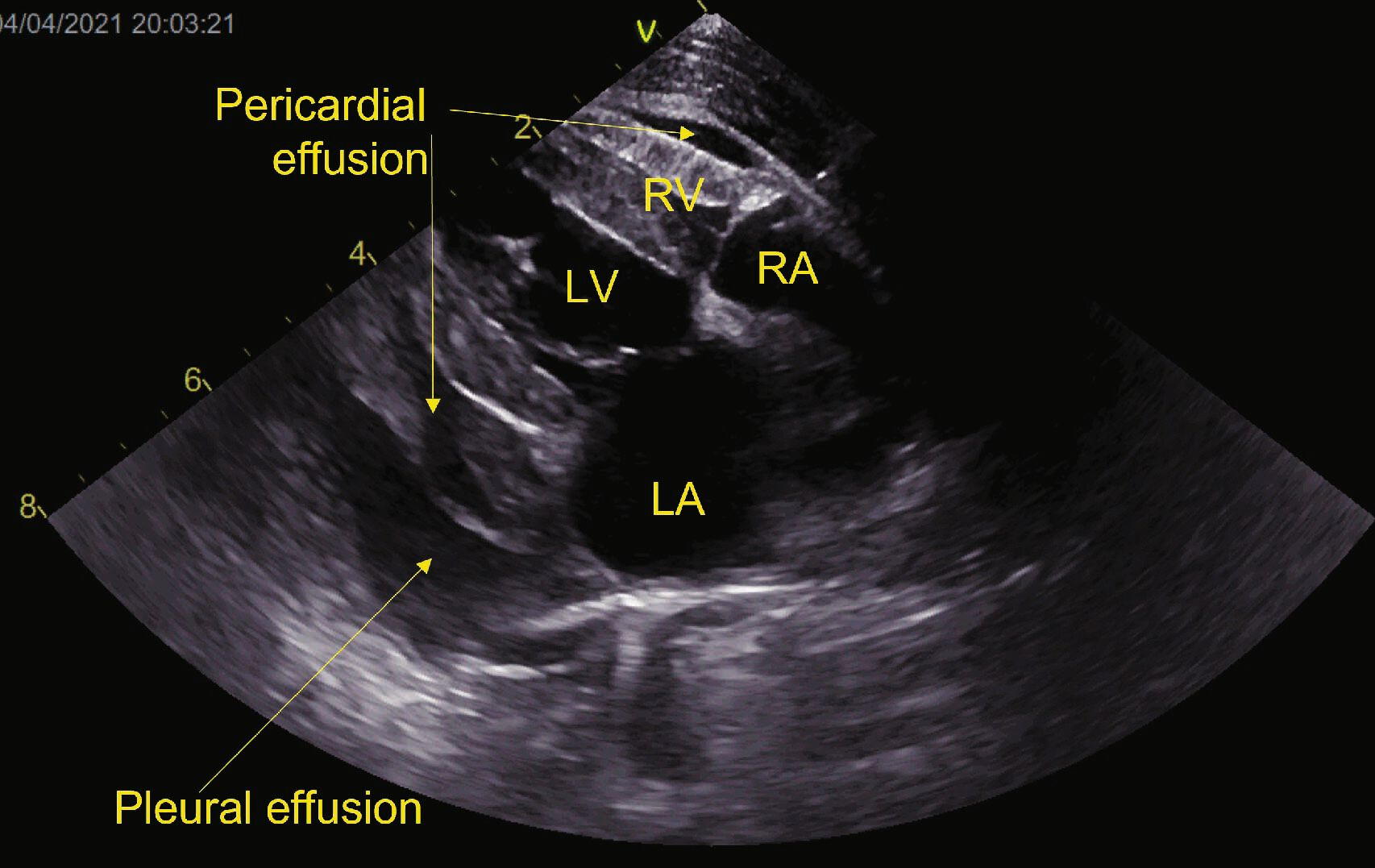 Mise en évidence par POCUS (« point of care ultrasound ») thoracique d’une ICC chez le chat