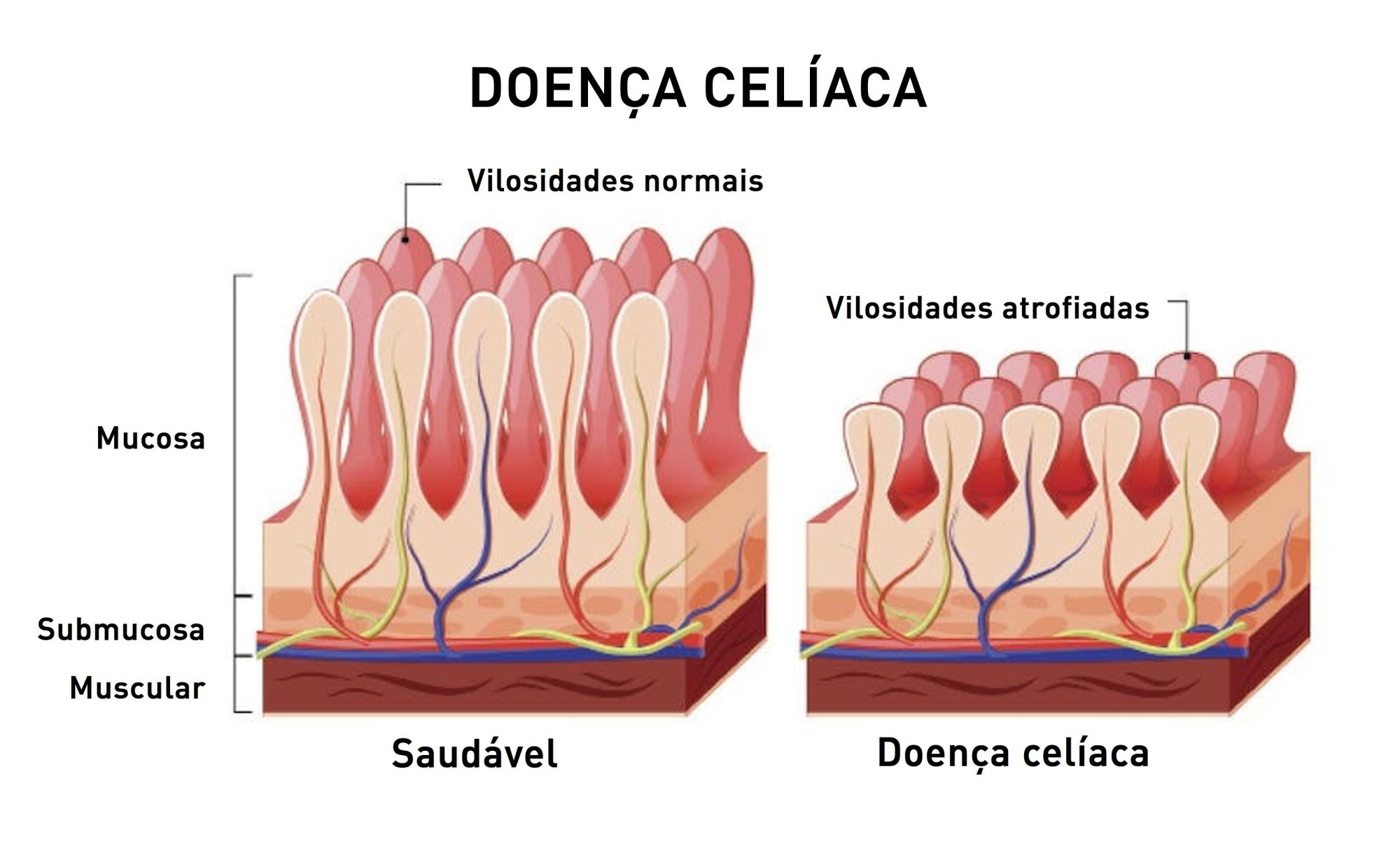 A doença celíaca é caracterizada pela perda da integridade das junções estreitas dos enterócitos e atrofia das vilosidades, o que altera a permeabilidade intestinal e leva a sinais clínicos como diarreia