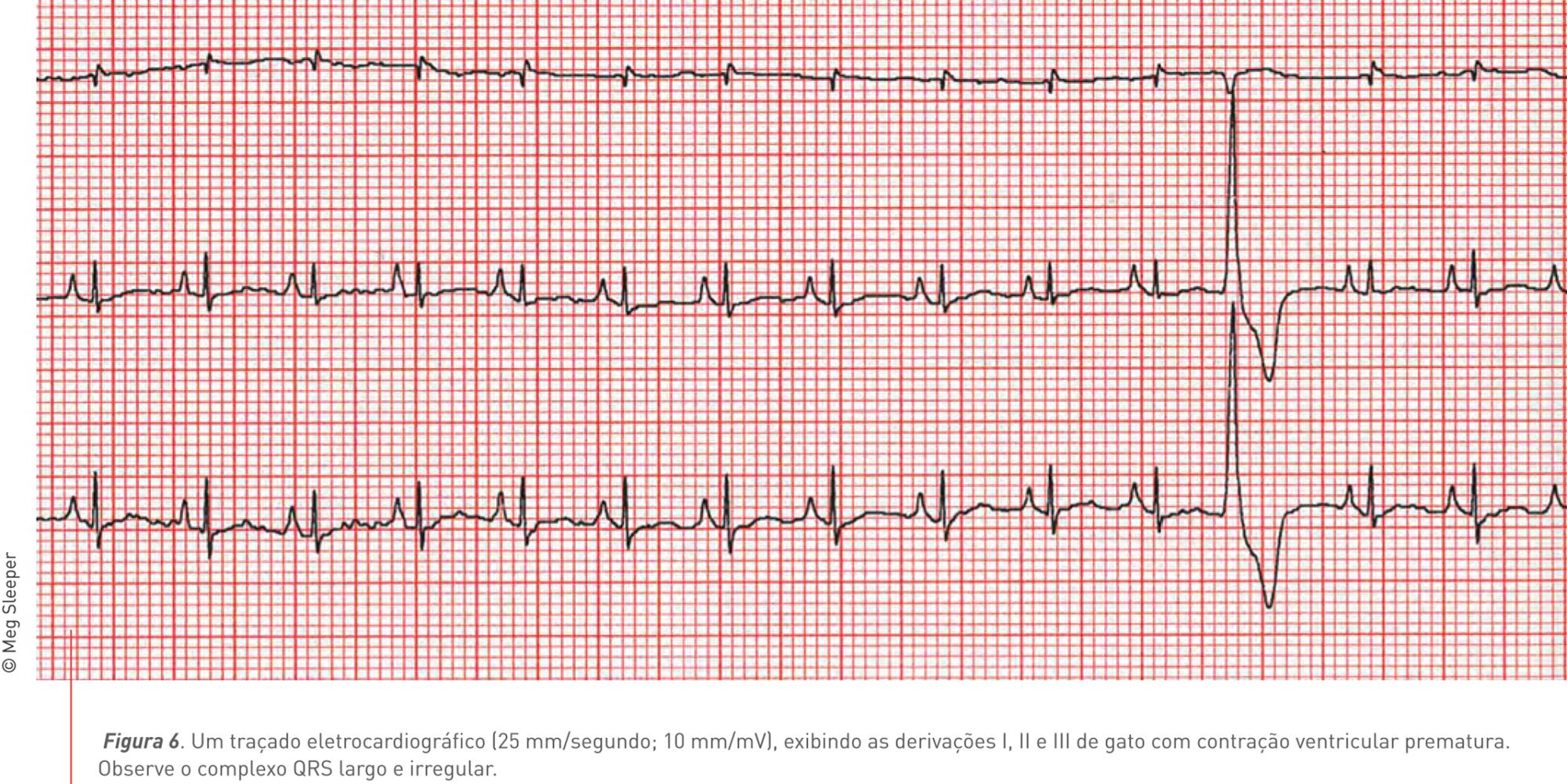 Figura 6. Um traçado eletrocardiográfico (25 mm/segundo; 10 mm/mV), exibindo as derivações