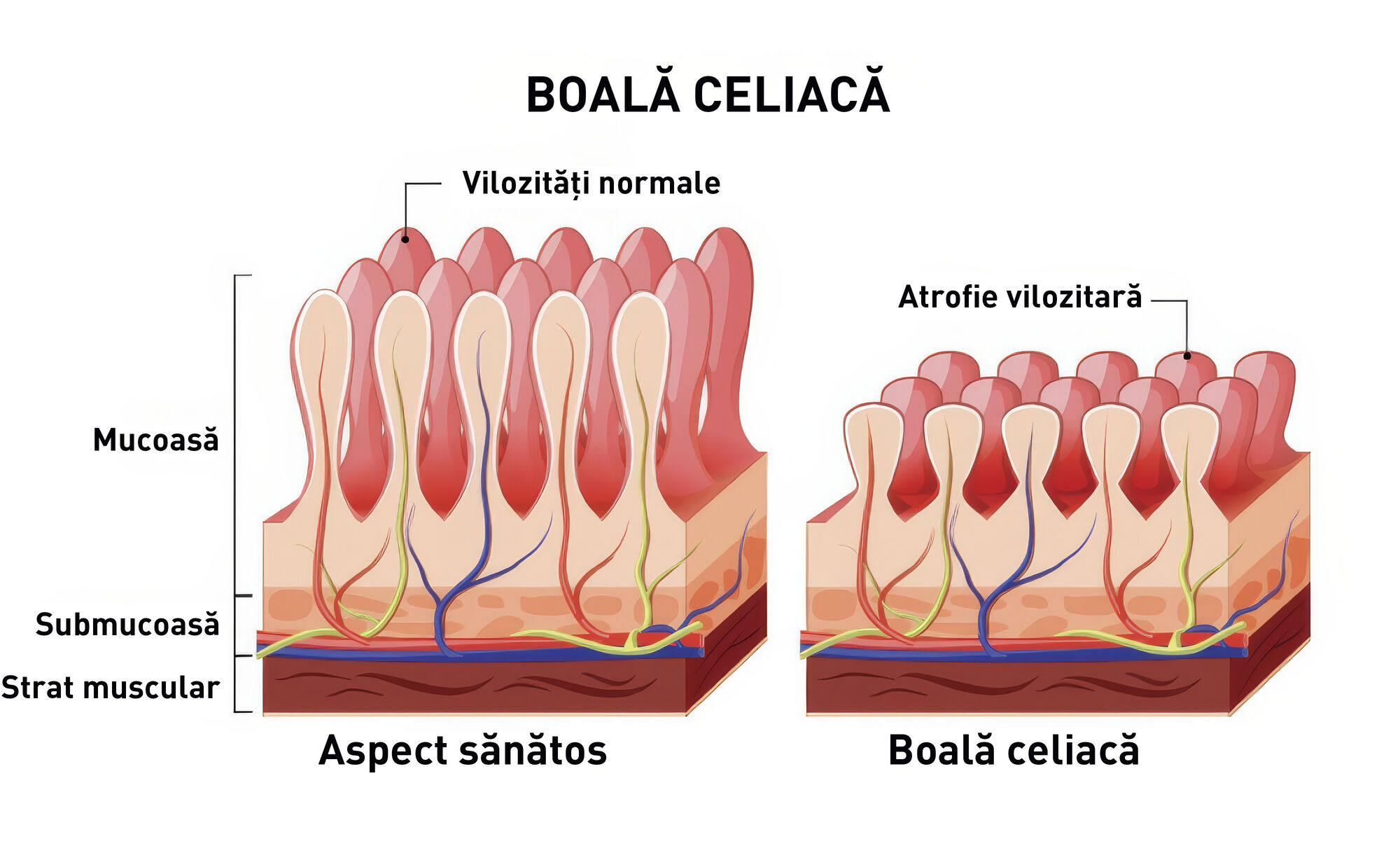 boala celiaca 
