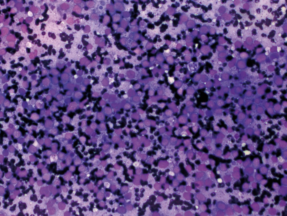 Echantillon de cytologie hépatique montrant une prolifération mononucléaire avec des nucléoles proéminents, compatibles avec un lymphome.