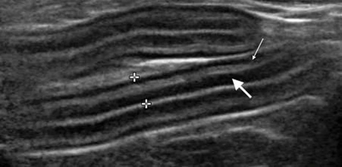 Ultrasonographic longitudinal image of the jejunum of a cat diagnosed with inflammatory bowel disease. The mucosal layer (large arrow) is more prominent than the muscularis layer (thin arrow) but this finding does not exclude the possibility of ScLSA. The overall bowel wall thickness (between calipers) was increased at 3.2 mm.