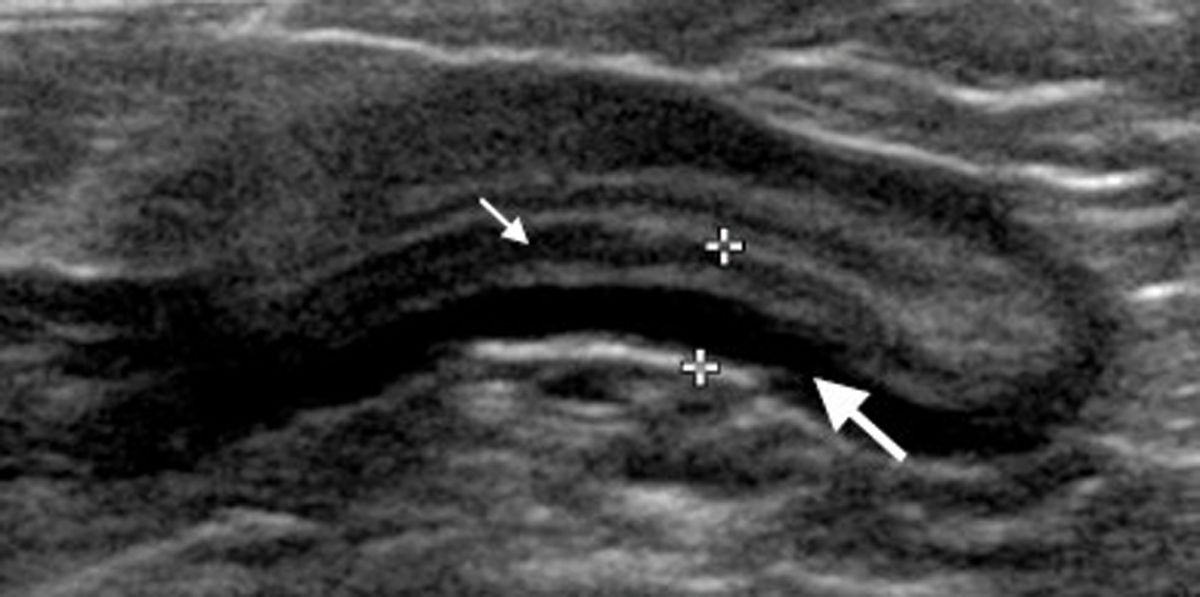 Längsschnittsonogramm des Jejunums einer Katze mit ScLSA. Die Muscularis (dicker Pfeil) ist prominent und dicker als die Mucosa (dünner Pfeil). Der Gesamtdurchmesser der Darmwand (zwischen den Markerkreuzen) war mit 4,2 mm erhöht.