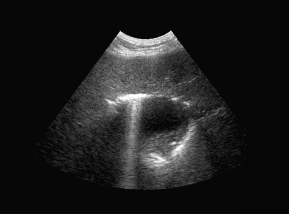 An abdominal ultrasound of a dog with gas in the gallbladder due to emphysematous cholangitis.