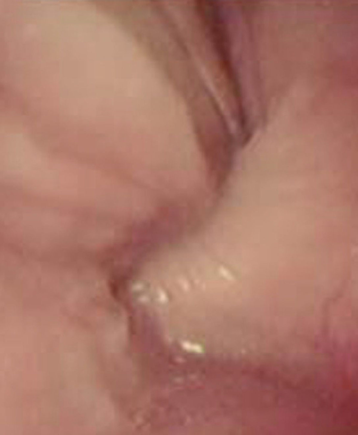 Compressione esofagea causata da un’anomalia dell’anello vascolare osservate mediante endoscopia.