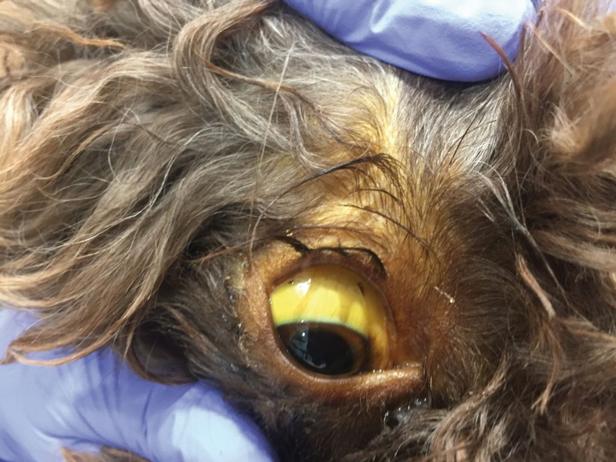 Icter scleral sever la un pacient cu colangită.