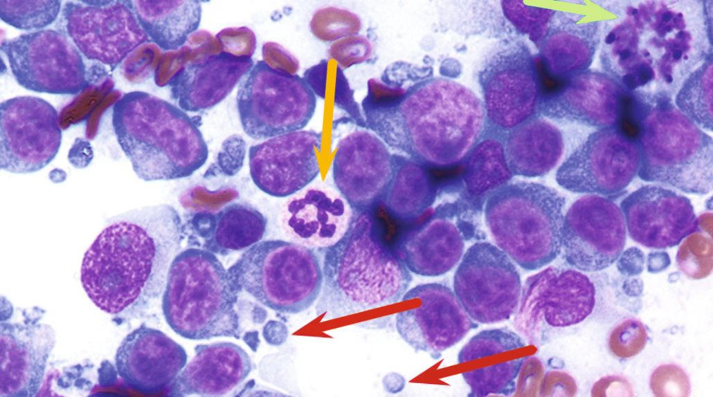 Cytology from a cytospin preparation of pleural fluid 