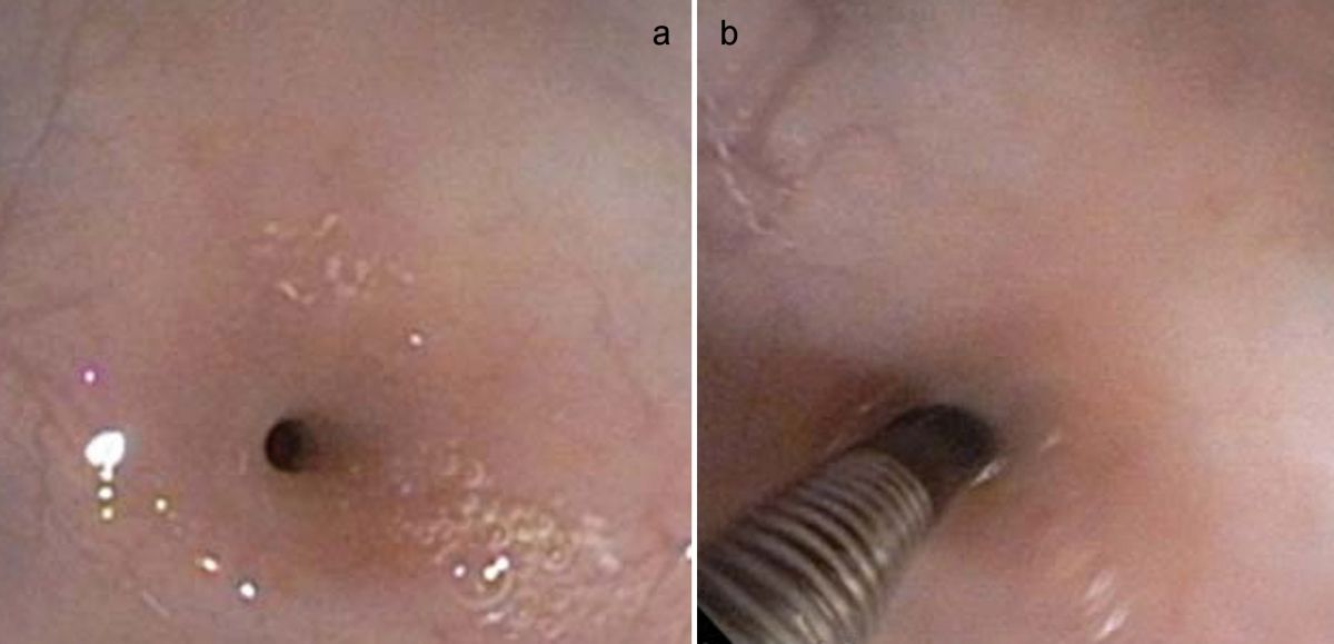 Aspect endoscopique d’une sténose oesophagienne (a). Le diamètre de l’oesophage au niveau de la sténose mesuré avec une pince est de 2 mm (b).