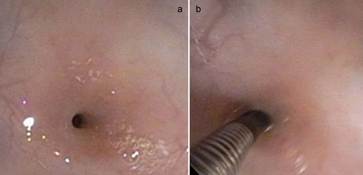 Aspetto endoscopico di una stenosi esofagea (a). Il diametro dell’esofago misurato con una pinza nella sede della stenosi era di 2 mm (b).