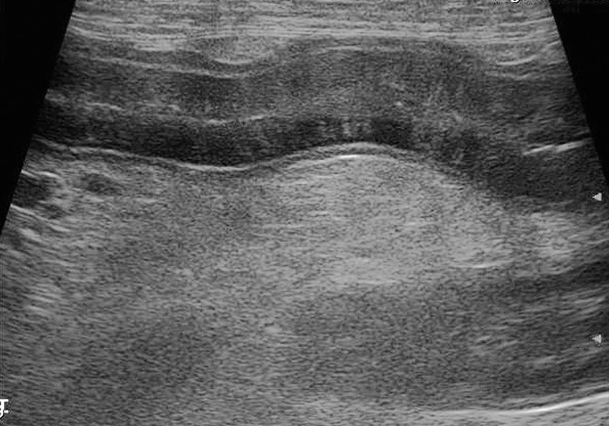 Imagen ecográfica del intestino delgado de un perro con diagnóstico confirmado de linfangiectasia. Nótense las líneas verticales en la mucosa.