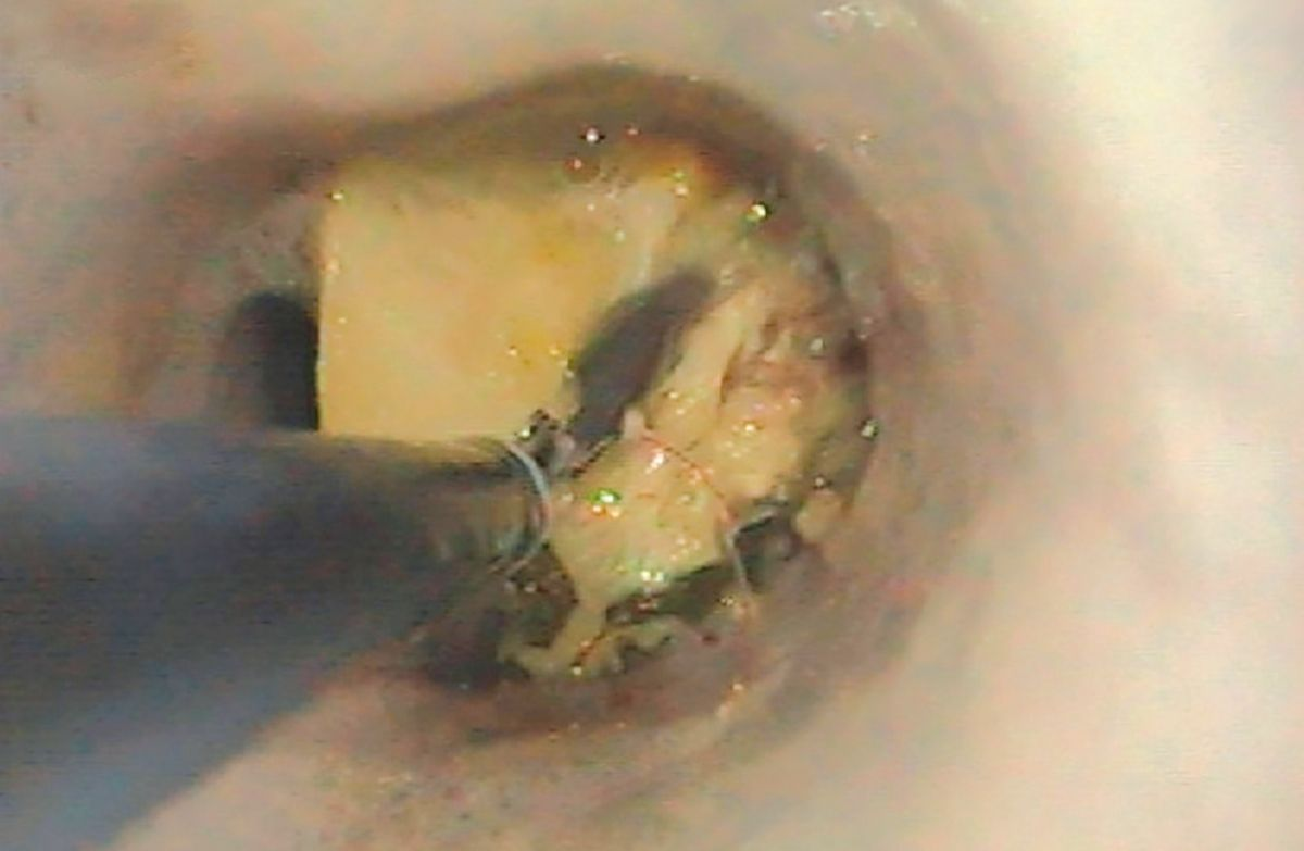 Endoscopia esofágica del Caso 1 que revela la presencia de un hueso de gran tamaño justo rostral al cardias.