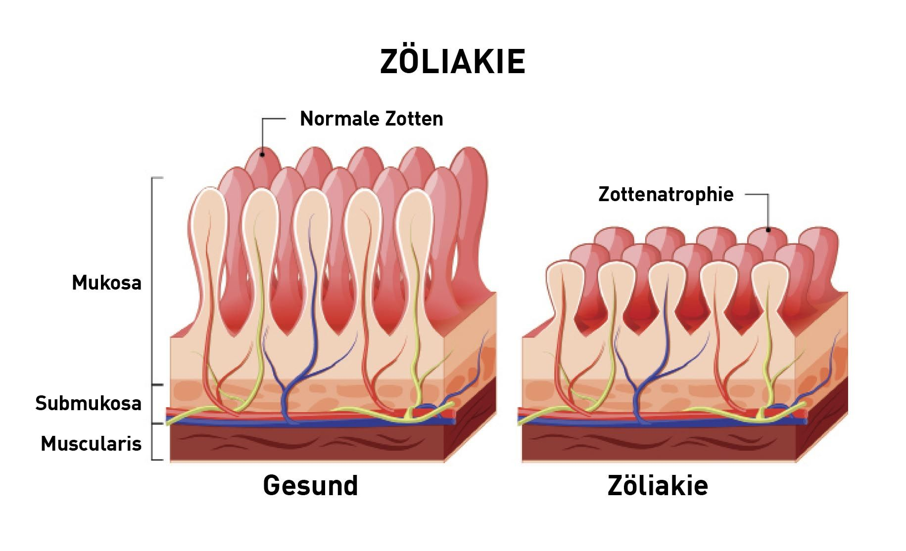Zöliakie ist gekennzeichnet durch einen Verlust der Integrität der Tight Junctions von Enterozyten und einer Zottenatrophie mit der Folge einer Veränderung der intestinalen Permeabilität und klinischen Symptomen wie Diarrhoe