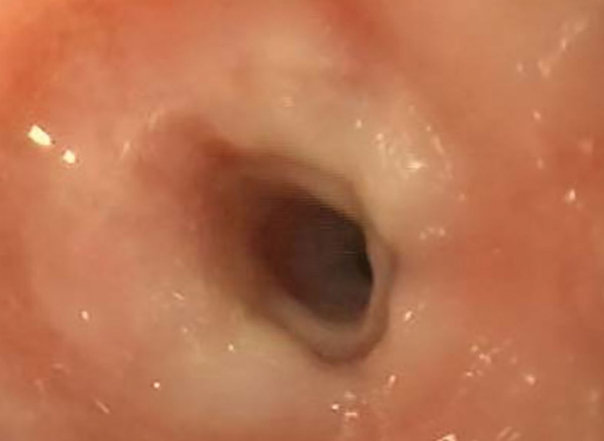 Esophageal endoscopy of Case 2 revealed a severe stricture with narrowing of the esophageal lumen