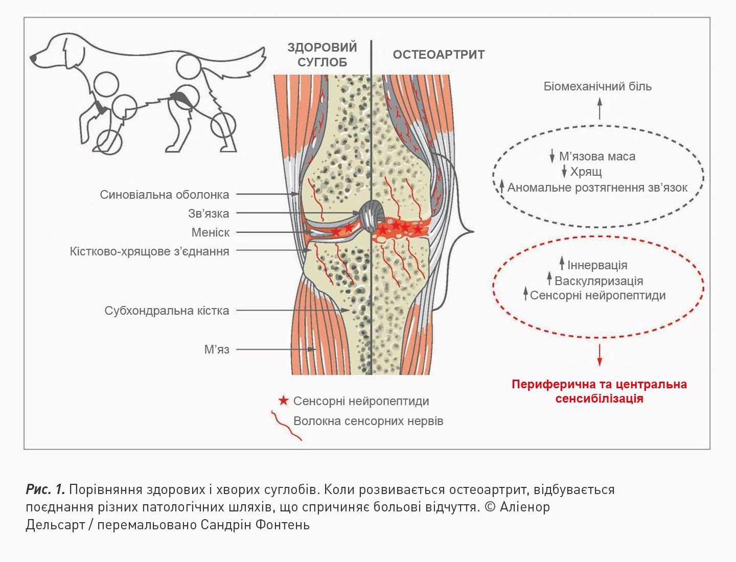 Рис. 1. Порівняння здорових і хворих суглобів. Коли розвивається остеоартрит